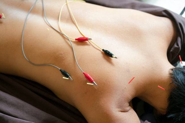 elektrotherapie-naturheilverfahren-liste-elektroakupunktur-wirkung-anwendung-akupunktur-stromtherapie-schöpferinsel-alternative-medizin